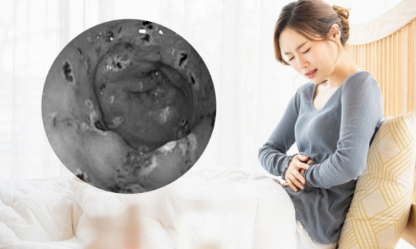 Dạ dày người phụ nữ 'thủng' đến 30 vết chỉ do một sơ suất, có vấn đề đường tiêu hoá đặc biệt lưu ý