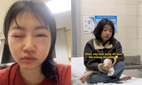 Nữ ca sĩ bị dị ứng sưng húp mắt ngay trước khi diễn countdown, mới đầu năm đã gặp 'kiếp nạn'!