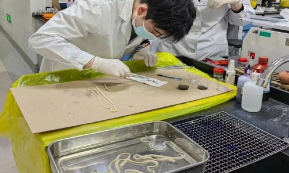 Sinh vật dài 4 mét bị “trục xuất” khỏi cơ thể cô gái trẻ, bác sĩ: thịt này ngon nhưng cẩn thận khi ăn