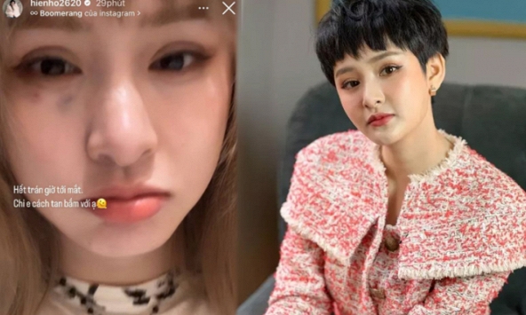 Hiền Hồ lộ diện với vết bầm lớn trên mặt, lại là chiêu trò PR sản phẩm mới?