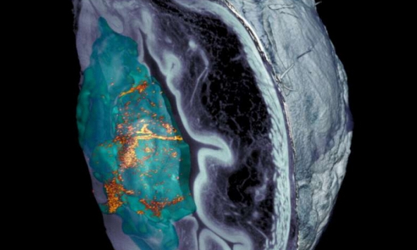 Một liều duy nhất của chế phẩm robot nano tự hành sử dụng năng lượng từ urê làm giảm 90% khối u bàng quang trong nghiên cứu trên chuột