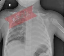 Phổi trái của bé trai 1 tuổi 'biến mất', thủ phạm bất ngờ là món ăn thường xuất hiện vào dịp Tết, phụ huynh cần cảnh giác