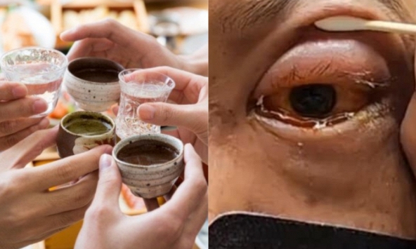 Người đàn ông 44 tuổi nguy cơ mù vĩnh viễn chỉ vì một sai lầm sau khi say, mạch máu trong nhãn cầu bị phá hủy nghiêm trọng