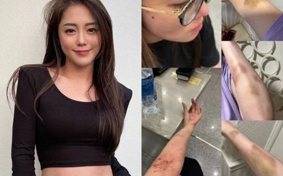 Nữ diễn viên tố bạn trai doanh nhân bạo hành dã man, công bố ảnh bị đánh bầm tím cả người gây chấn động showbiz