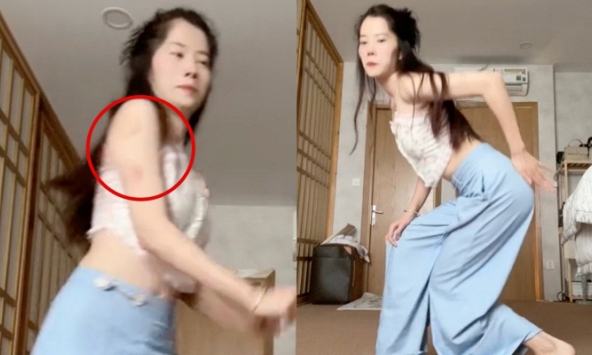 Nam Em tự đăng clip tập nhảy với biểu hiện bất ổn, loạt vết bầm trên tay gây chú ý