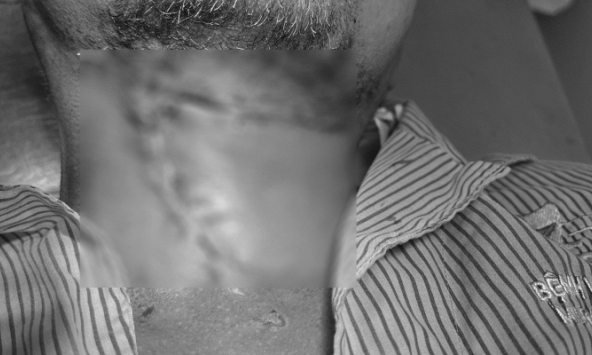 Người đàn ông ở TP.HCM đau răng 10 ngày không khỏi, bác sĩ mở vùng dưới hàm phát hiện cả ổ mủ 'bốc mùi'