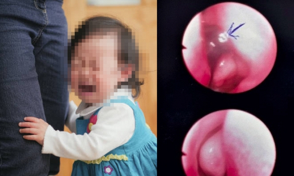 Bé gái 13 tháng tuổi ở Bình Thuận khóc dữ dội sau khi tắm suối, gia đình tá hỏa khi thấy sinh vật lạ lấp ló trong lỗ mũi 