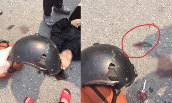 Cô gái ở Hà Nội bị mảnh vỡ của mũ bảo hiểm cắt vào đầu sau va chạm với xe ba gác