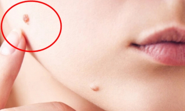 Phụ nữ bị nổi mụn cóc ở 5 vị trí này coi chừng đã nhiễm HPV, tiềm ẩn nguy cơ ung thư cổ tử cung và bệnh tình dục