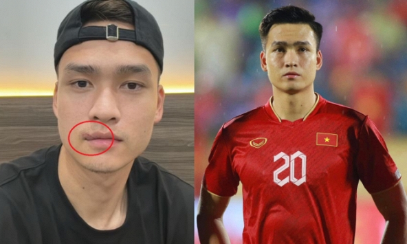 Bùi Hoàng Việt Anh than 'mồm méo' khi cắt chỉ 24 mũi khâu vết rách môi, độ điển trai của nam thần tuyển Việt Nam liệu có sụt giảm?