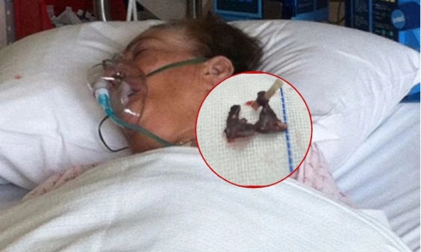 Nghẹt 1 bên mũi suốt nửa năm, người phụ nữ rùng mình khi bác sĩ lấy ra 2 cục đen cứng như đá bốc mùi hôi thối