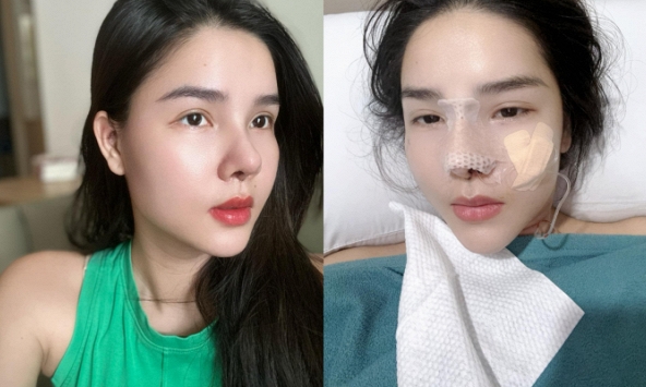 Kỳ Hân - vợ Mạc Hồng Quân khoe mũi sau phẫu thuật thẩm mỹ nhưng dân tình lại khen mũi cũ đẹp hơn