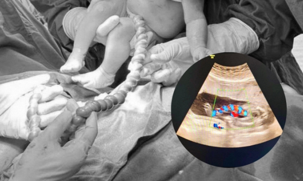 Sản phụ 20 tuổi chuyển dạ, bác sĩ siêu âm giật mình trước hình ảnh bất thường của dây rốn: Mổ lấy thai khẩn cấp!