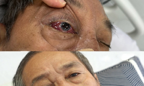 Thường xuyên bị đỏ mắt và ù tai, người đàn ông nhập viện trong tình trạng hôn mê sâu, phổi rất xấu