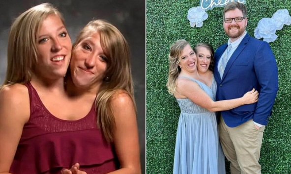 Cặp song sinh dính liền nổi tiếng nhất thế giới: Dùng chung một cơ thể suốt 34 năm, cuộc sống hiện tại gây kinh ngạc