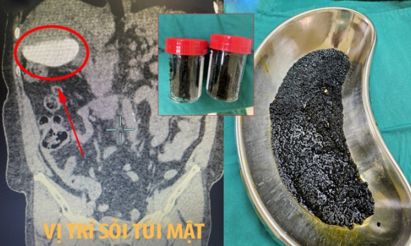 Choáng với số lượng viên sỏi nhiều không đếm xuể khi cắt túi mật cho người phụ nữ ở Vĩnh Long