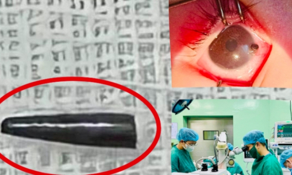 Ruột bút chì xuyên thủng nhãn cầu mắt của bé trai 9 tháng tuổi ở Nghệ An