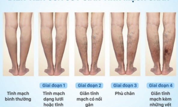 Tầm soát - phòng ngừa - cải thiện tình trạng “Suy giãn tĩnh mạch”