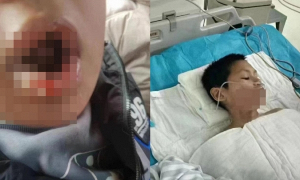 Vụ nam sinh cấp 2 bị bạn học ép uống nước sôi: Phía cơ quan chức năng đưa ra tuyên bố gây bất bình