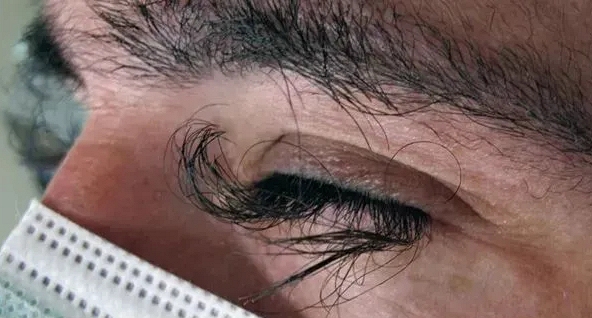 Lông mi của người đàn ông mọc dài, cong vút sau khi hóa trị ung thư