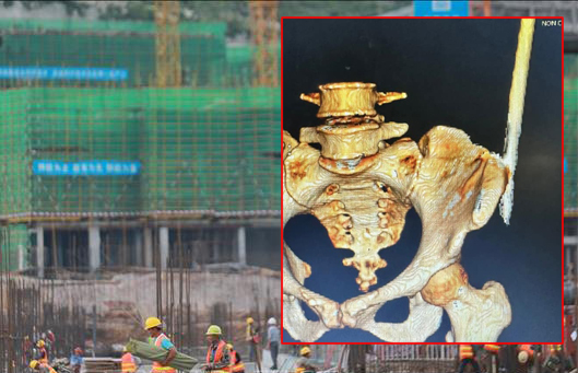 Thêm 1 vụ tai nạn lao động ở công trường xây dựng, nữ công nhân bị thanh sắt rơi trúng, đâm xuyên người