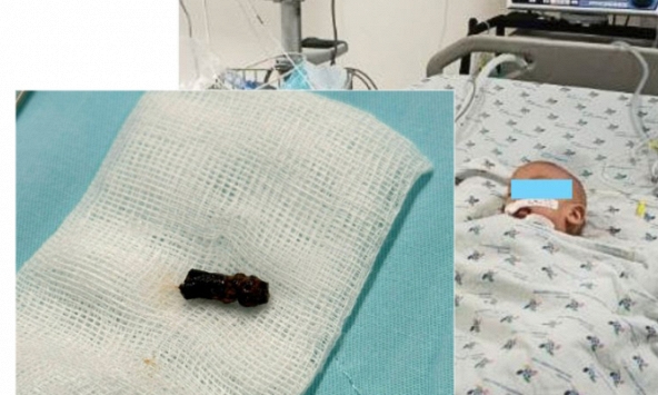 Bé trai 8 tháng tuổi chơi với trái xoài rồi đột ngột ho sặc sụa, nhập viện trong tím tái: 2 Bệnh viện phối hợp lấy dị vật