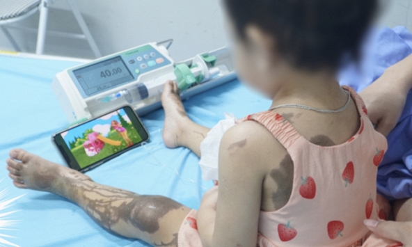 Bị đổ cả chai nước thông cống lên người, bé gái 25 tháng tuổi bỏng nặng