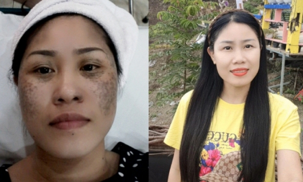 Hành trình lột xác từ 'mặt đen tối sầm' thành 'mặt hoa da phấn' của người phụ nữ 40 tuổi sau 3 năm từ Điện Biên về Hà Nội