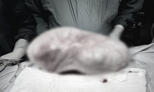 TP.HCM: Bé gái 12 tuổi bụng to dần rồi đau âm ỉ, gia đình sửng sốt sau khi đưa đi khám