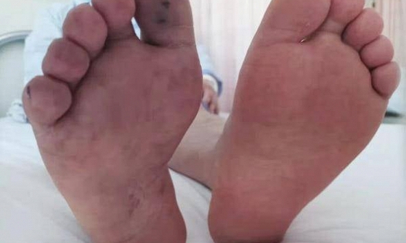 Nam sinh 17 tuổi phát hiện vết hoại tử thâm đen, suýt phải cắt cụt chân, bác sĩ bất lực vạch trần sai lầm suốt 3 năm qua