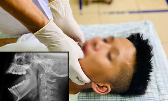 Phú Thọ: Nam thanh niên không khép miệng lại được vì ngáp lớn đến sái quai hàm