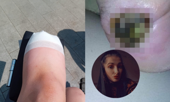 Cô gái 24 tuổi phải cắt cụt một chân vì vết phồng rộp nhỏ do đi giày thể thao, cảnh báo 'điều có thể xảy ra với bất cứ ai'