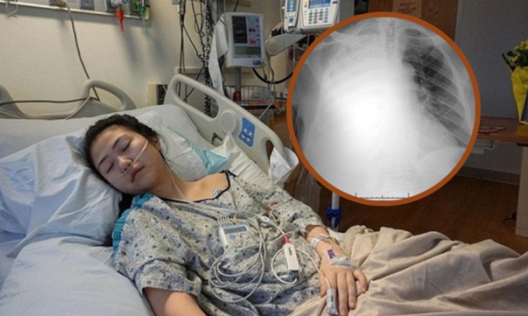 Một thói quen khiến phổi người phụ nữ trắng xoá, suy giảm 60% chức năng phổi và vĩnh viễn không thể phục hồi