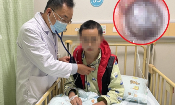 Cậu bé 13 tuổi nhiễm trùng phổi tái phát suốt 4 năm vì một chiếc vỏ 'kẹt' bên trong