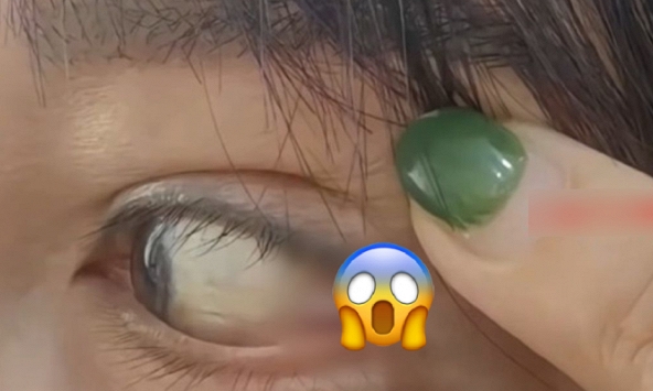 Bỏ 105 triệu cắt mắt 2 mí, người phụ nữ kinh hoàng phát hiện...