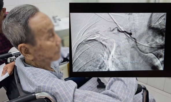 Cụ ông 87 tuổi bị 'ho ra máu sét đánh', tỷ lệ tử vong gần như 100% và kỳ tích xảy ra
