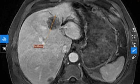 Hà Nội: Một bệnh nhân phát hiện ung thư đã di căn vì bỏ qua dấu hiệu âm ỉ suốt 3 tháng