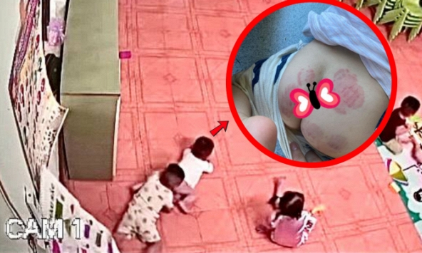'Sốc' với hình ảnh vết răng đỏ chi chít trên mông em bé ở lớp mầm non: Trẻ bị bạn cắn nguy hiểm thế nào?