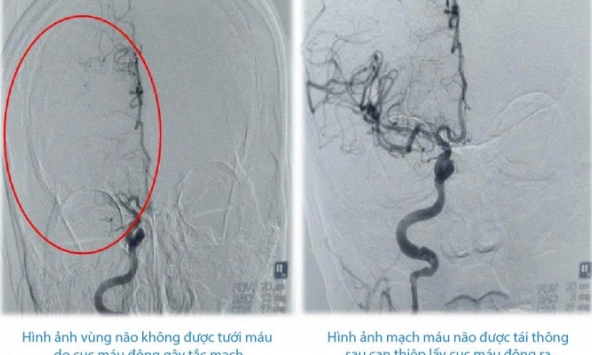 Choáng với thứ dài đến 10cm được lấy ra khỏi mạch máu não của người đàn ông 60 tuổi