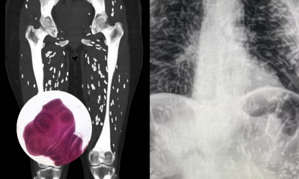 Sán làm tổ khắp người, tất cả do một kiểu nấu thịt lợn nhiều người Việt thường xuyên mắc phải