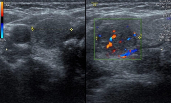 Ung thư tuyến giáp ngày càng trẻ hoá: Bác sĩ chỉ ra những dấu hiệu cần khám ngay nếu không muốn hối hận!