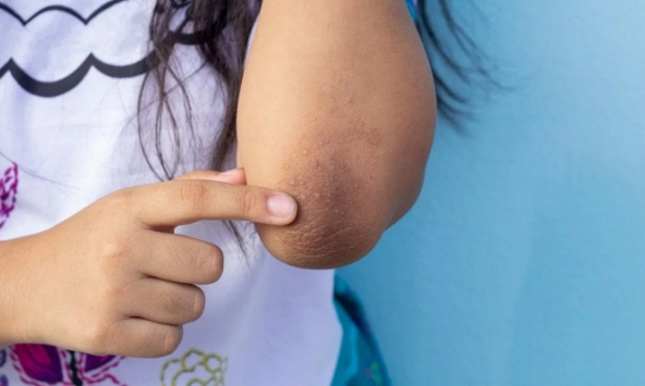 “1 đen, 2 hôi” trên cơ thể là tín hiệu tiểu đường sớm nhưng nhiều người nhắm mắt làm ngơ