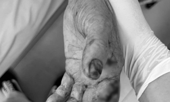 Điện thoại phát nổ khi rút sạc, người phụ nữ ở Phú Thọ bị chấn thương nặng, gãy đốt ngón tay