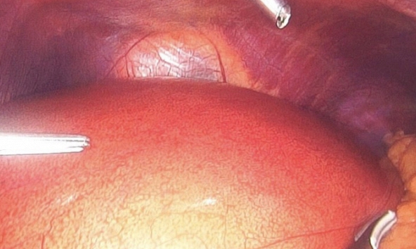 Siêu âm bụng phát hiện nhiều người trẻ mỡ phủ trắng gan, nguyên nhân vì đâu?