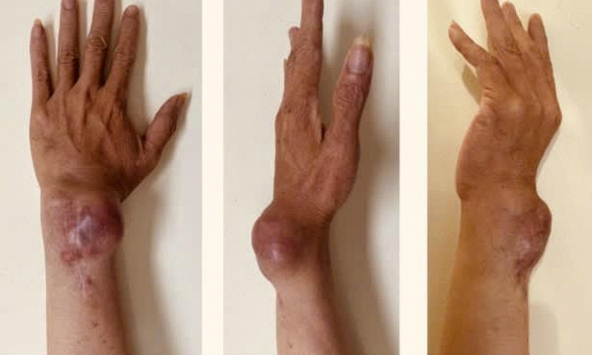 Cổ tay bỗng nhiên sưng lớn, đau nhức vì bệnh nguy hiểm