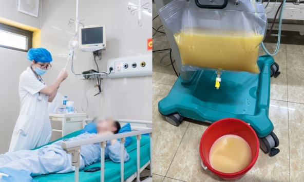 Người đàn ông ở Tuyên Quang phải lọc máu do viêm tuỵ cấp, hình ảnh xô chứa toàn mỡ được tách từ máu bệnh nhân khiến bác sĩ bất ngờ