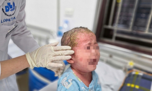 Bé 23 tháng tuổi trợt loét toàn thân, vảy đóng kín đầu do tắm lá, bôi thuốc không rõ nguồn gốc