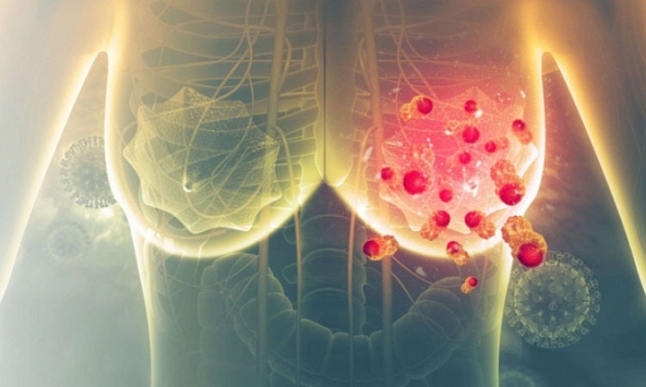 Căn bệnh ung thư đứng đầu tại Việt Nam với 24.563 ca mỗi năm