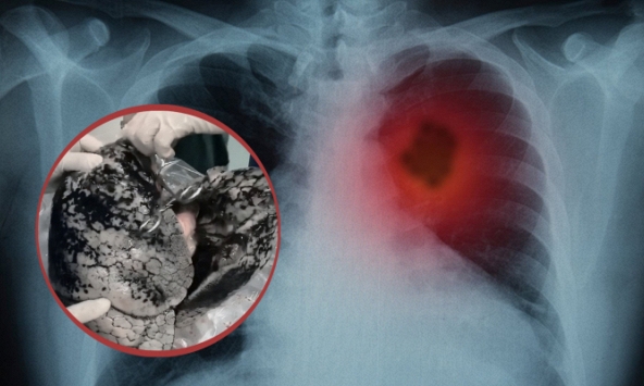 'Rửa phế quản cho người hút thuốc lá, dịch rửa đen như nước cống': Câu nói của bác sĩ khiến người hút thuốc lâu năm rùng mình