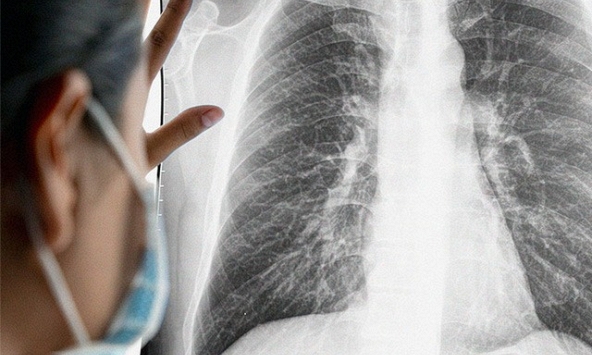 Cảnh giác với các nốt nhỏ ở phổi: Nơi những tế bào ung thư phát triển âm thầm